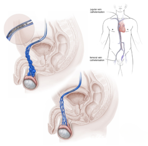 Varicocele Embolization