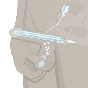 Coloplast Titan Penile Implant