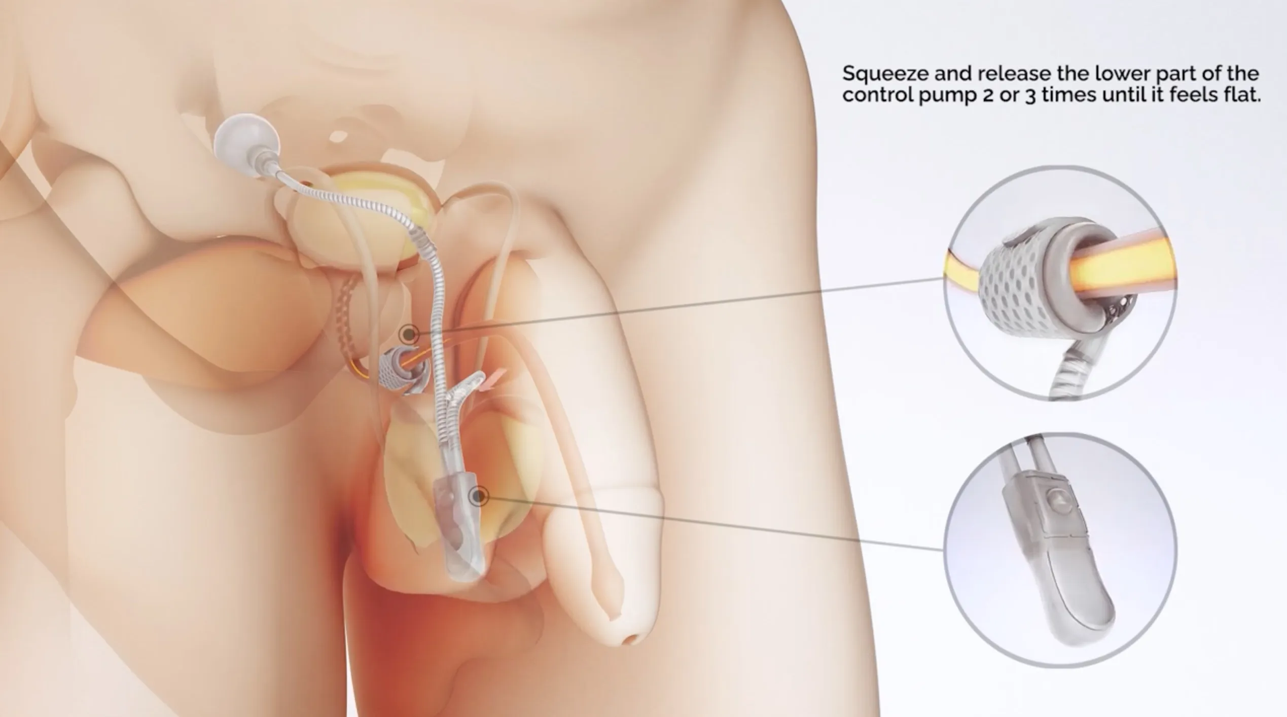 How the Artificial Urinary Sphincter Works