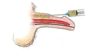     penile fat transfer