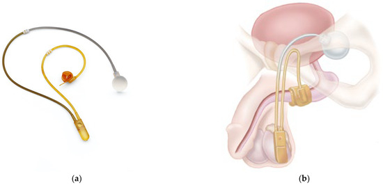Artificial Urinary Sphincter Surgery