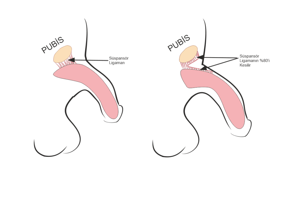 penile lengthening Surgery