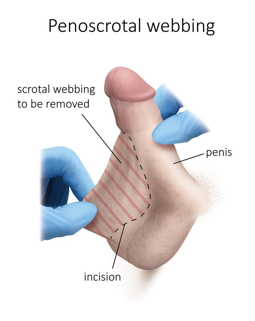 Corrective surgery for penoscrotal webbing
